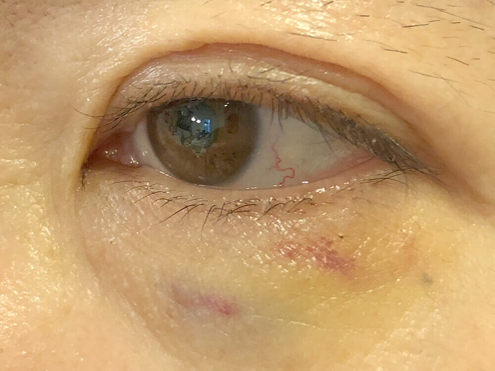 ボトックス注射の副反応の例