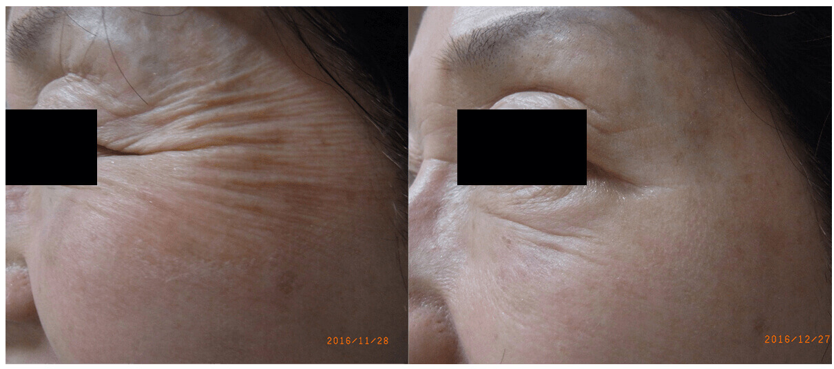 ボトックス注射前後写真