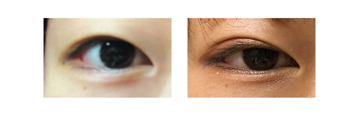 二重瞼手術 埋没式前後写真
