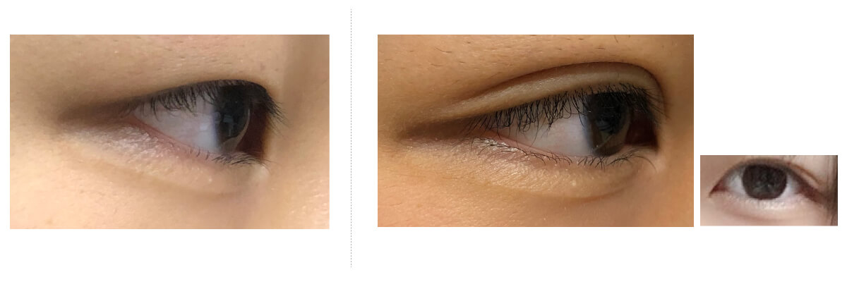 二重瞼手術 切開式前後写真