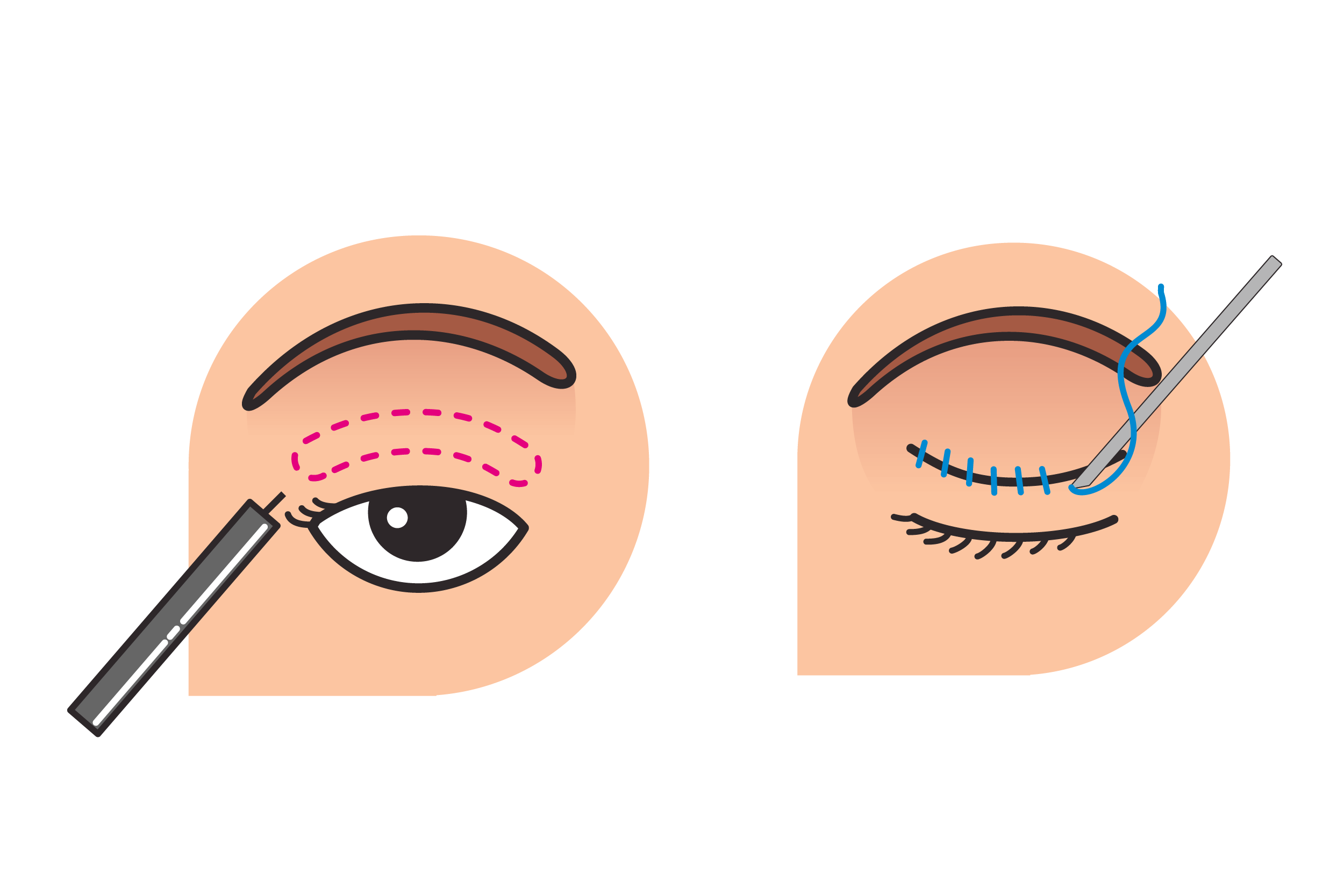 二重まぶた切開式の図