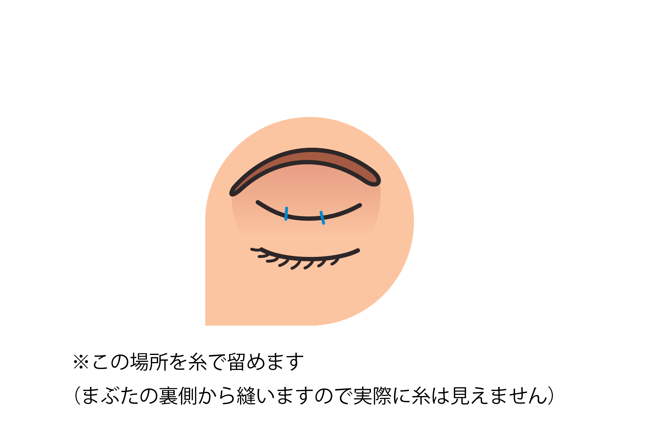 二重まぶた埋没式の図