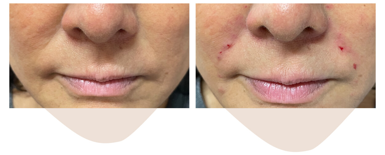 ヒアルロン酸注入前後写真