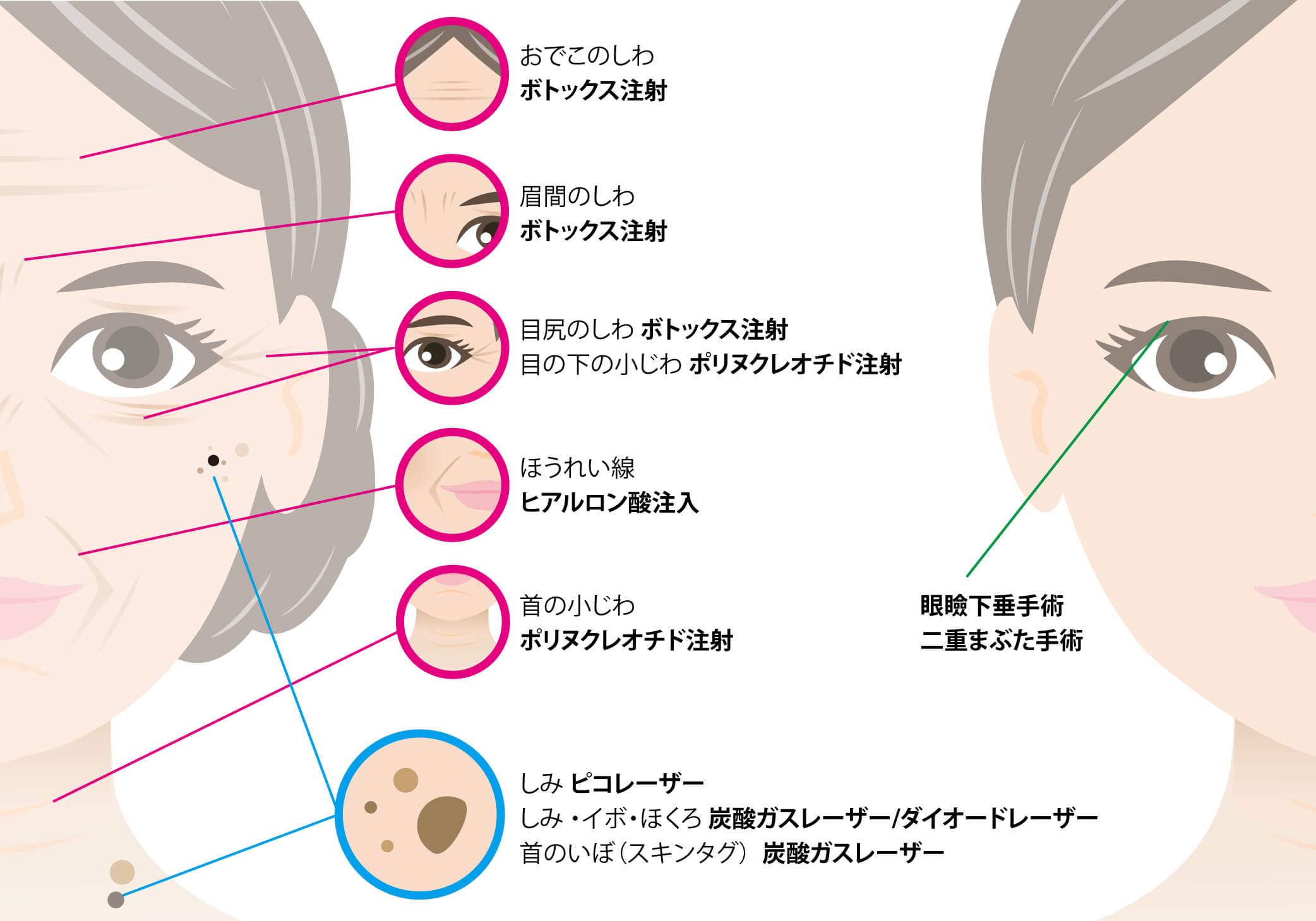 ボトックス・ヒアルロン酸・ポリヌクレオチド・リジュラン・ピコレーザー・二重まぶた手術・眼瞼下垂・シミ取り・シワ取り