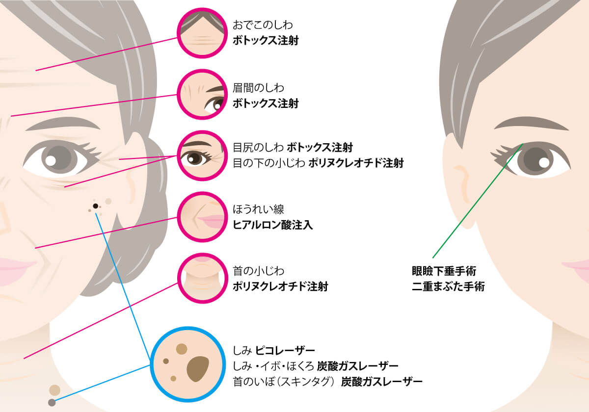 ボトックス・ヒアルロン酸・ポリヌクレオチド・リジュラン・ピコレーザー・二重まぶた手術・眼瞼下垂・シミ取り・シワ取り