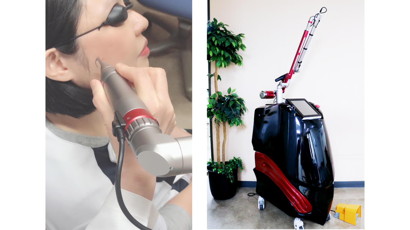 ピコレーザーしみ取り