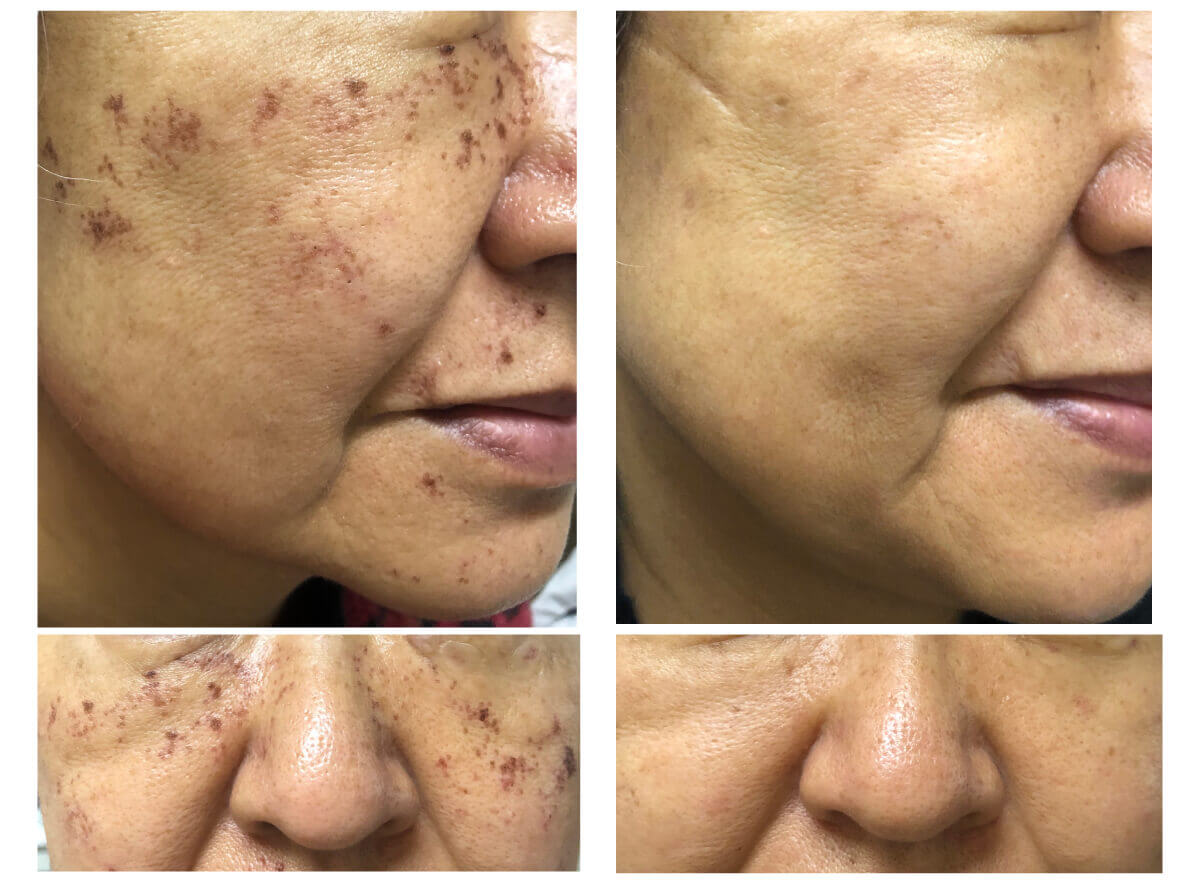 ピコレーザーによるしみ取り症例前後