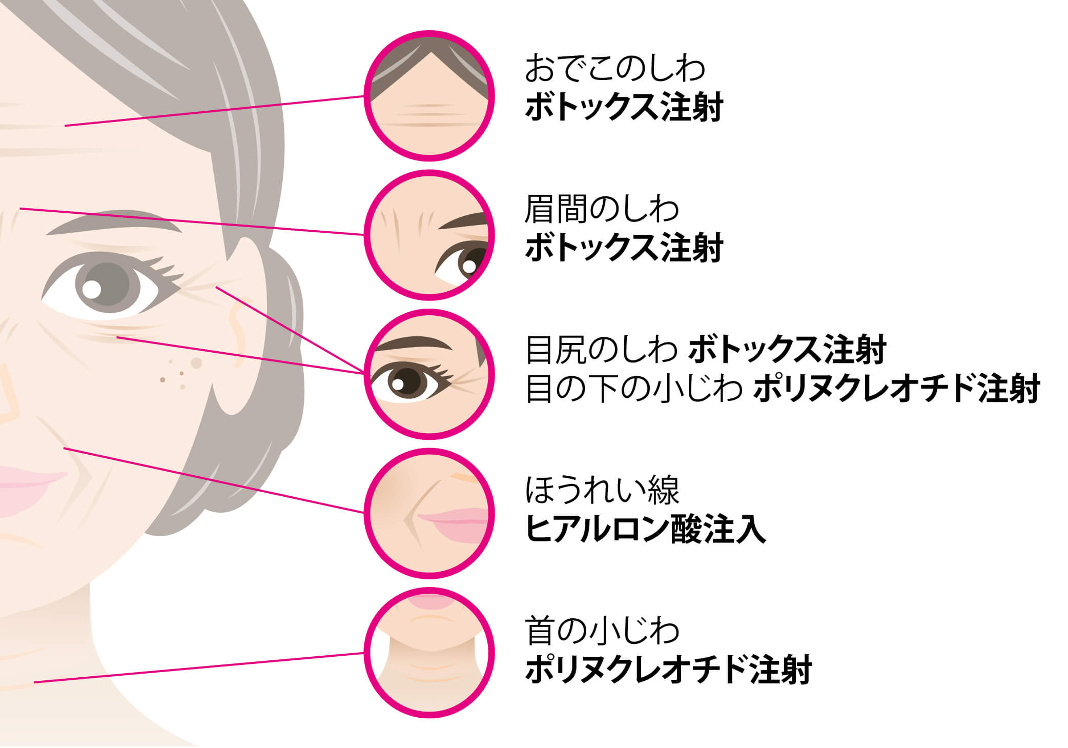 ボトックス注射・ヒアルロン酸注入・ポリヌクレオチド注射