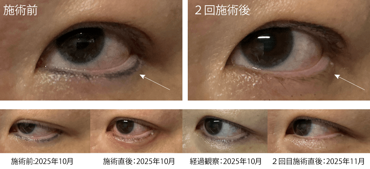 アートメイク　アイライン除去レーザー前後写真