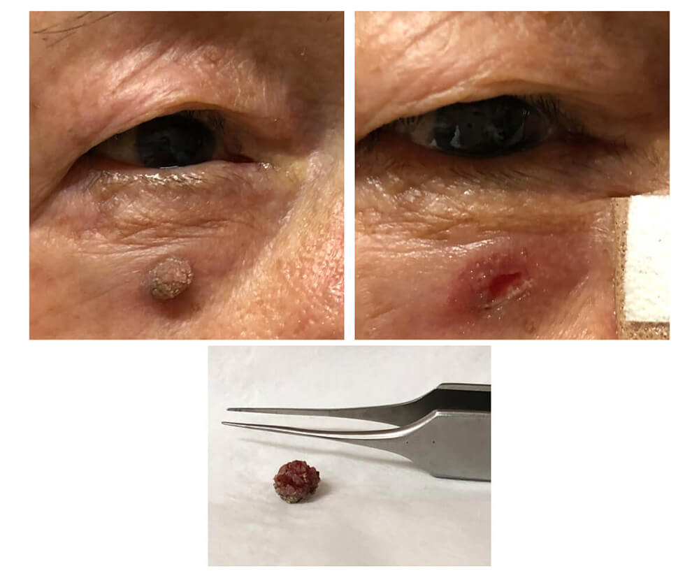 医療用レーザーによるいぼ取り症例前後