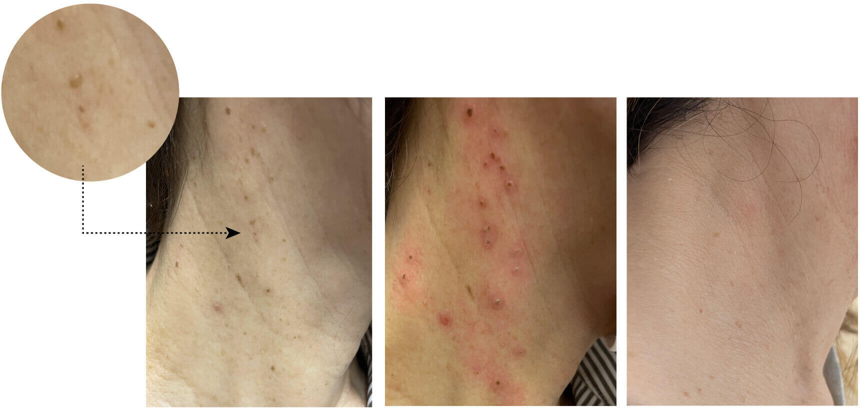 医療用レーザーによる首のいぼ(スキンタグ)取り症例前後