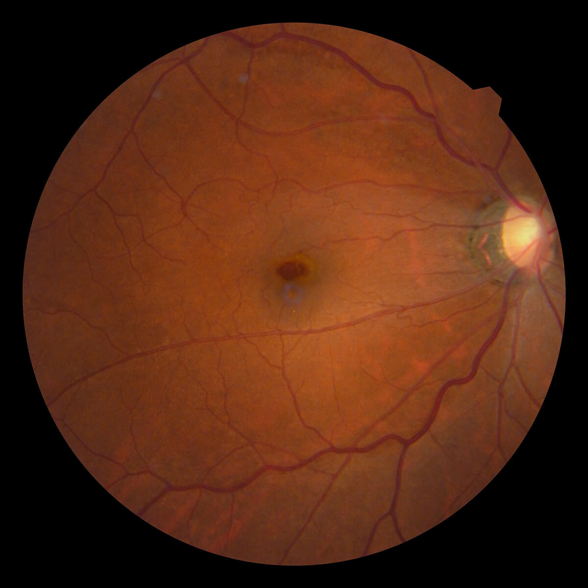 黄斑円孔+黄斑前線維症 手術前・手術後