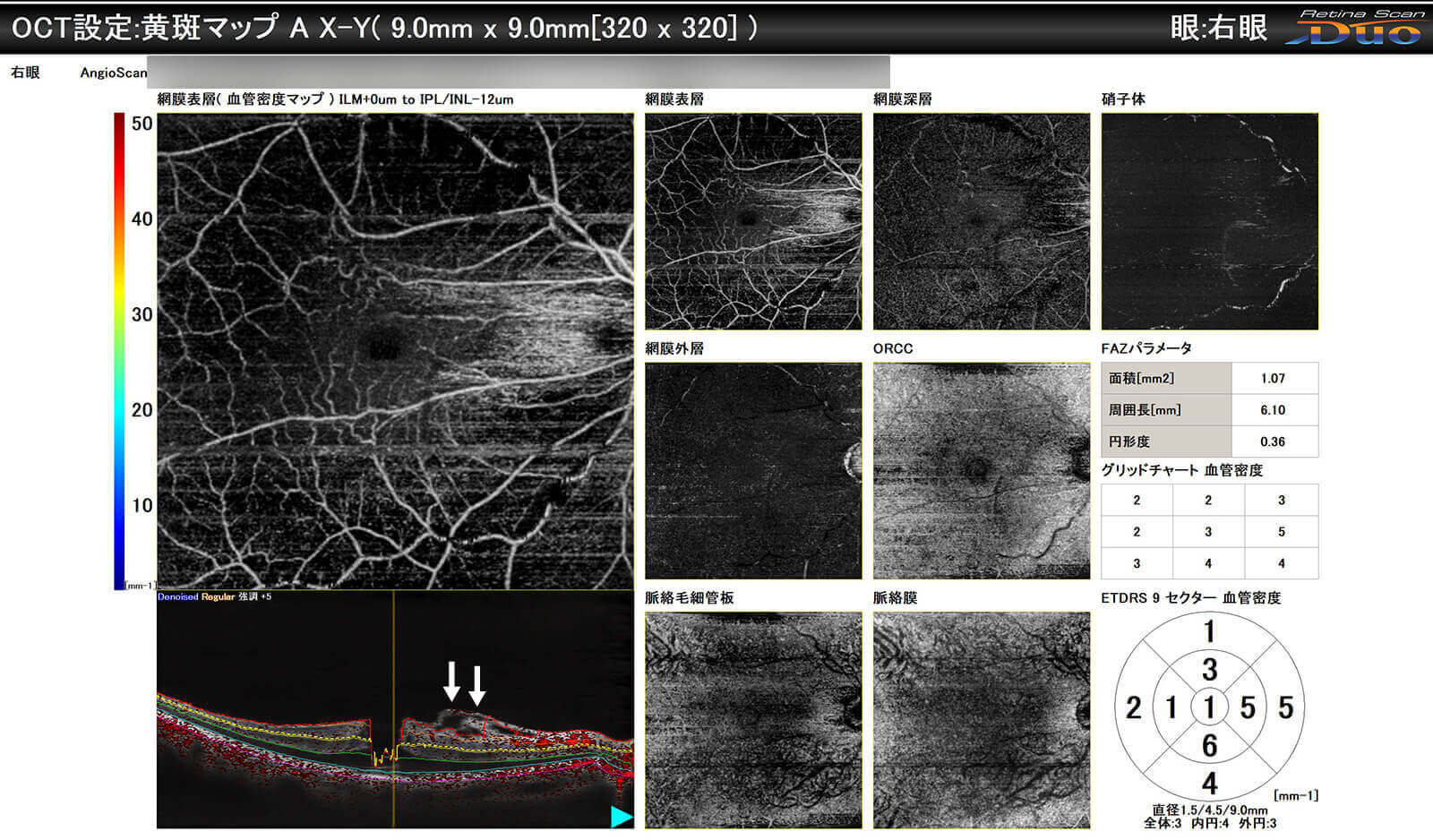 黄斑円孔+黄斑前線維症 手術前・手術後