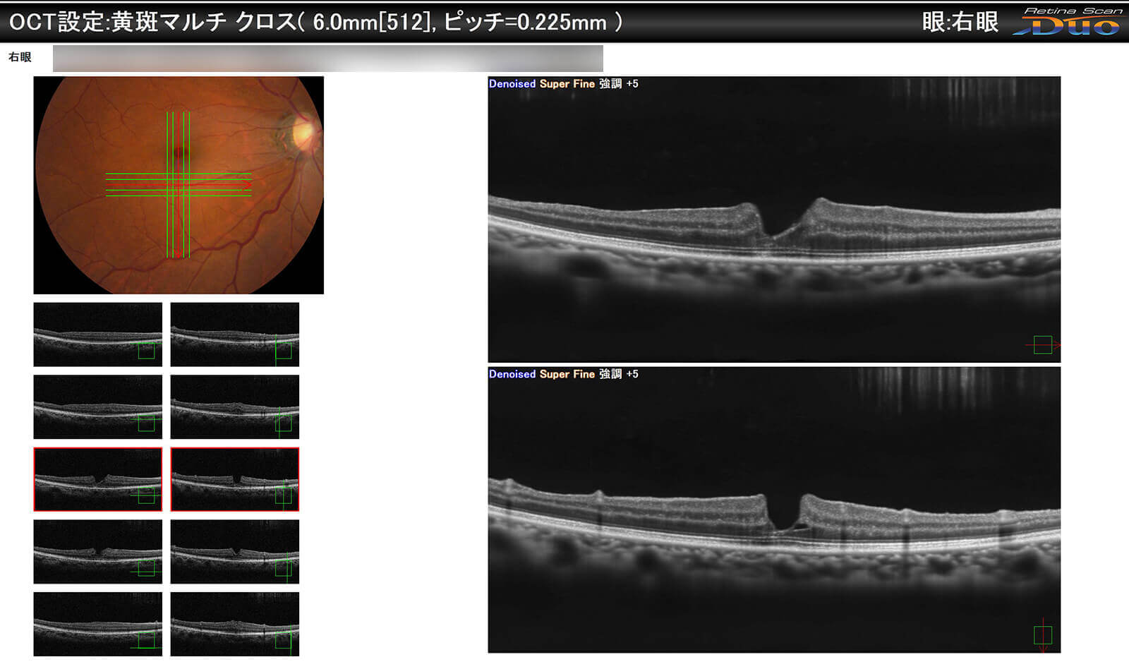 黄斑円孔+黄斑前線維症 手術前・手術後