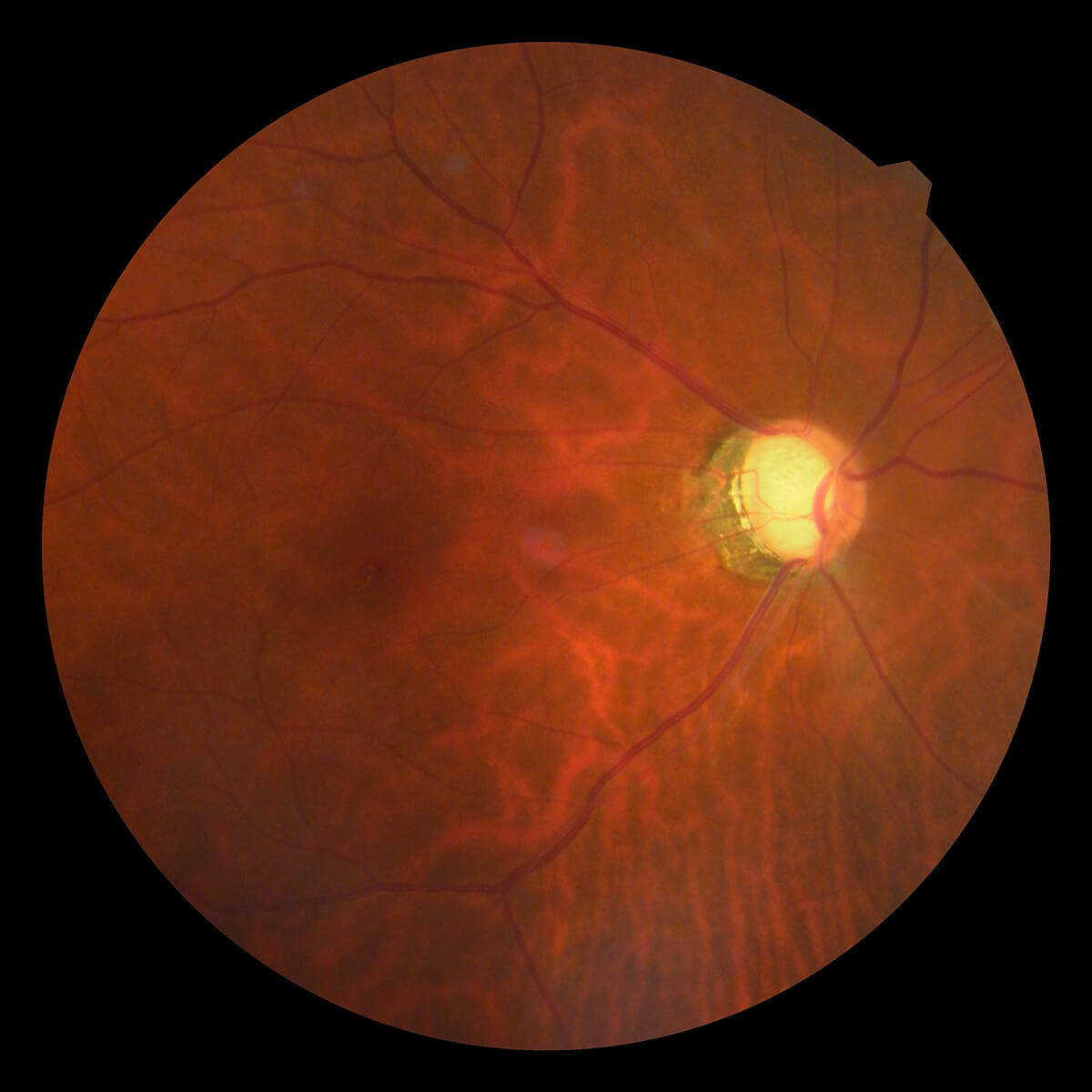 眼底写真緑内障