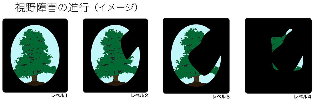 緑内障の視野の変化の図