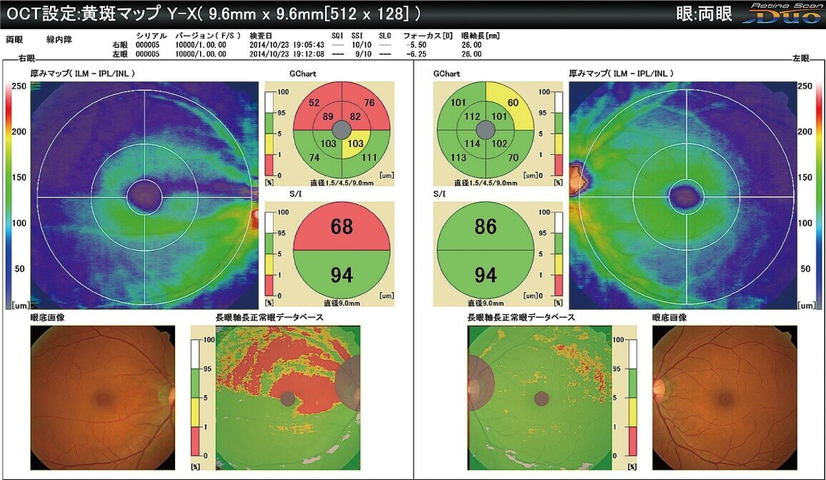 長眼軸正常眼データベースソフト