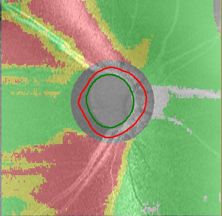 OCT検査画像緑内障