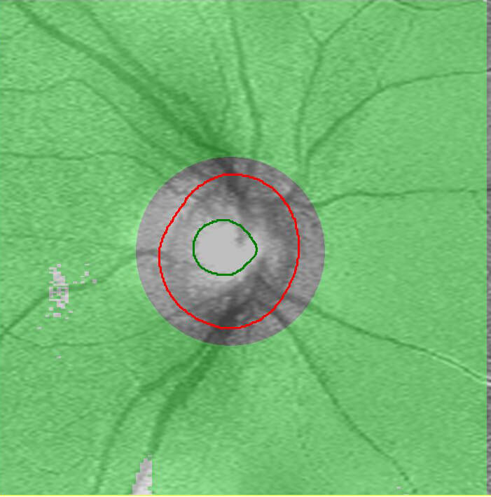 OCT検査画像正常