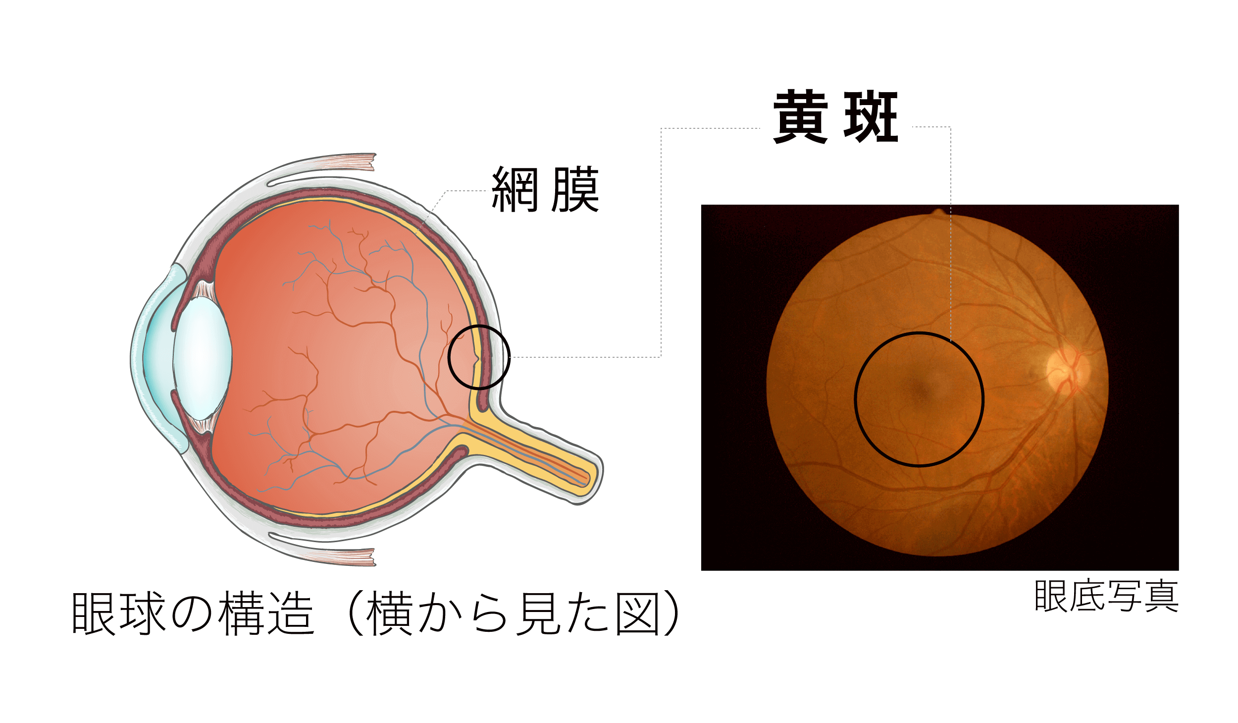 加齢黄斑変性の図解
