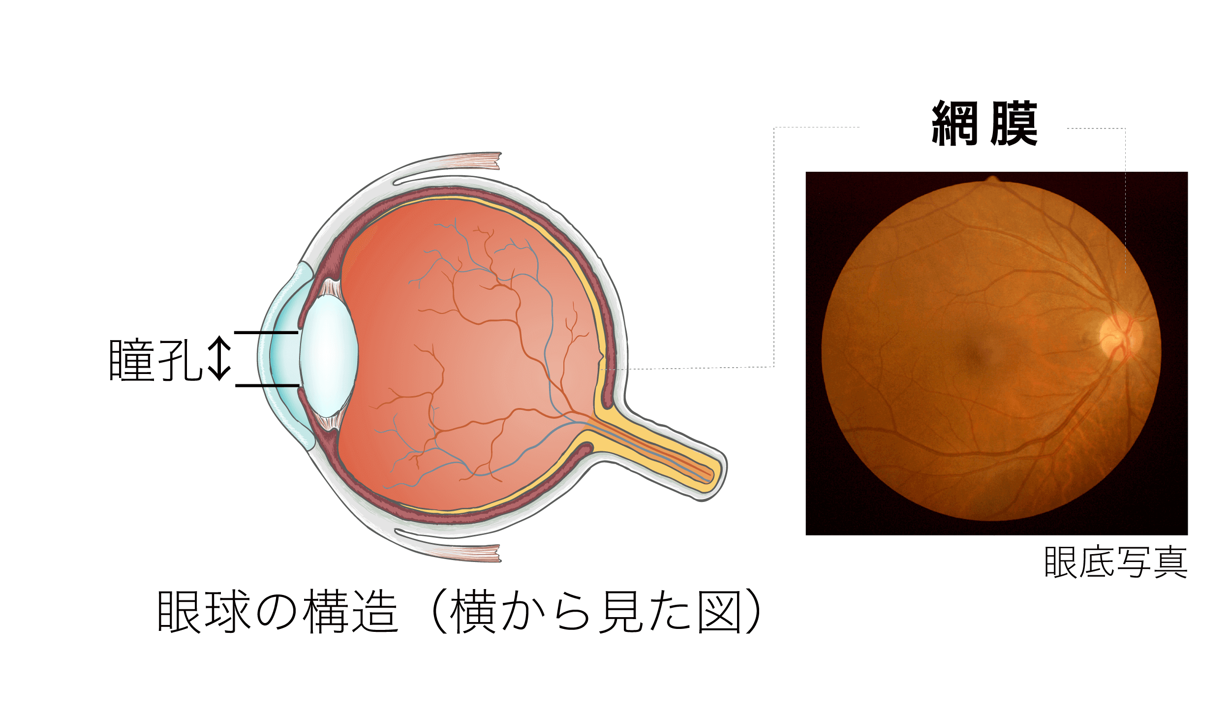 糖尿病網膜症の図解