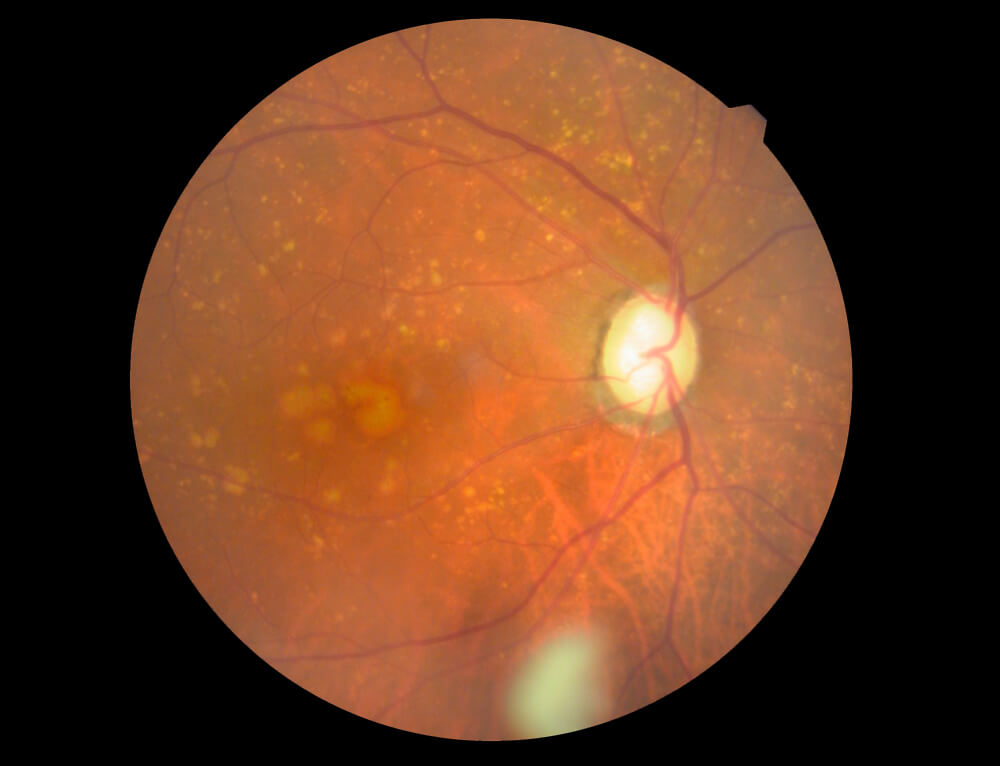 加齢黄斑変性の眼底写真