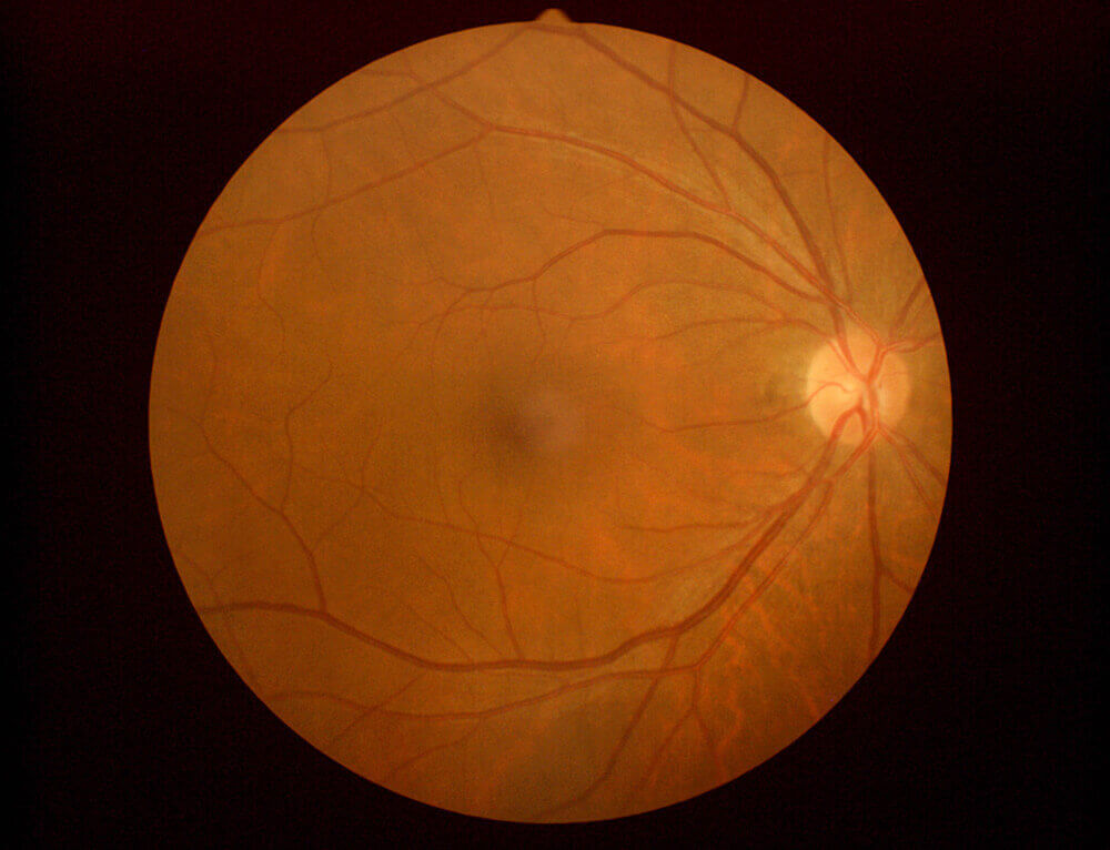 健康な目の眼底写真