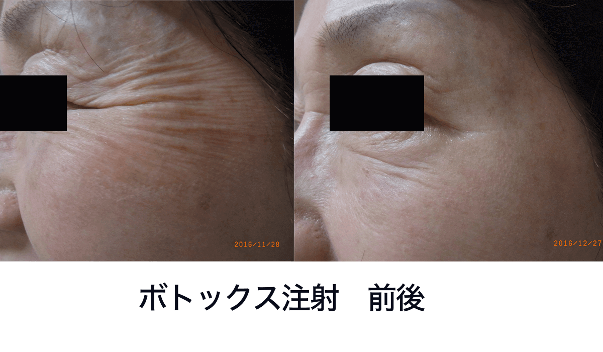 ヒアルロン酸注入・ボトックス注射など