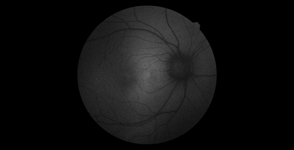 自発蛍光撮影(FAF)