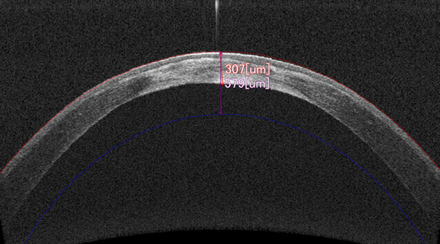 OCT撮影 円錐角膜