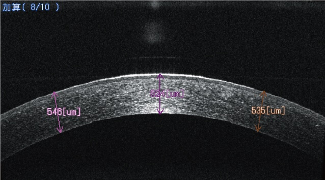 OCT撮影 正常角膜