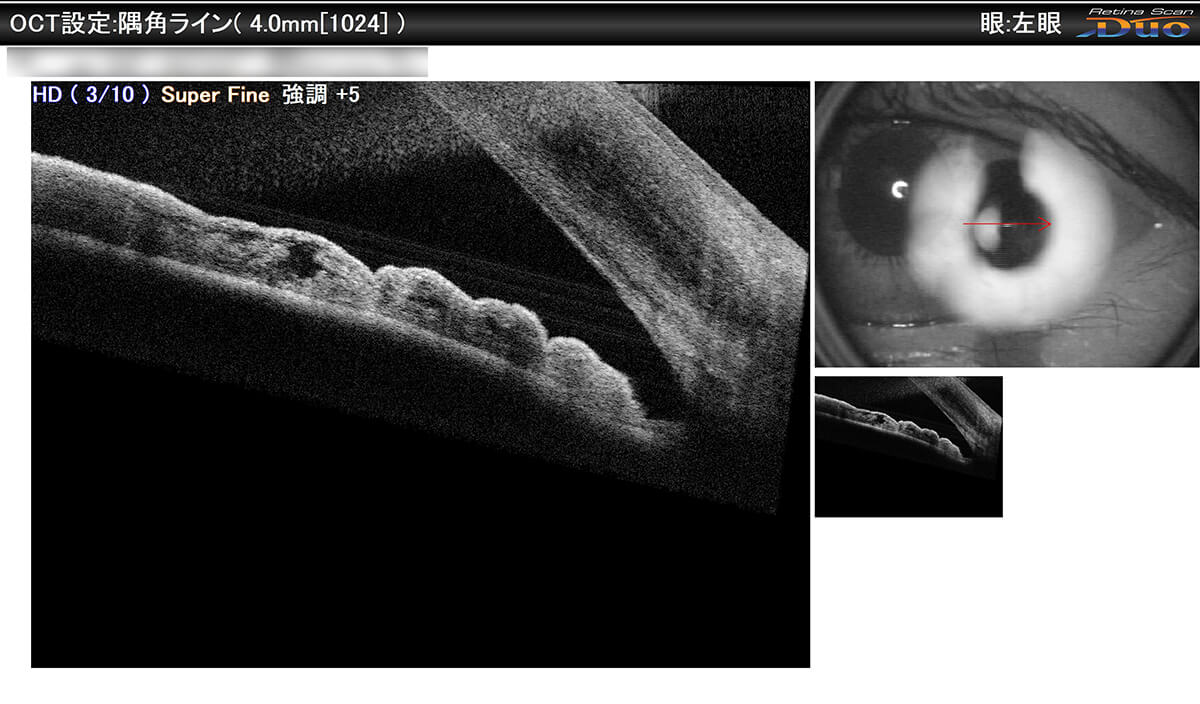 OCT撮影 隅角正常