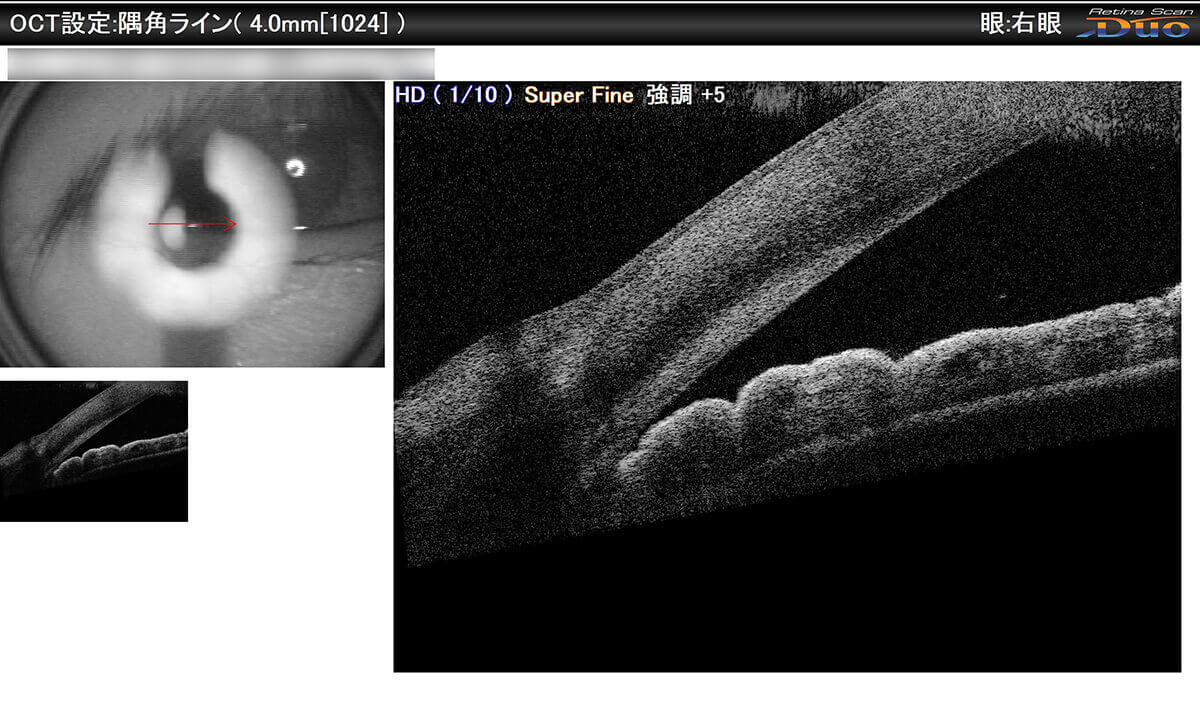 OCT撮影 隅角正常