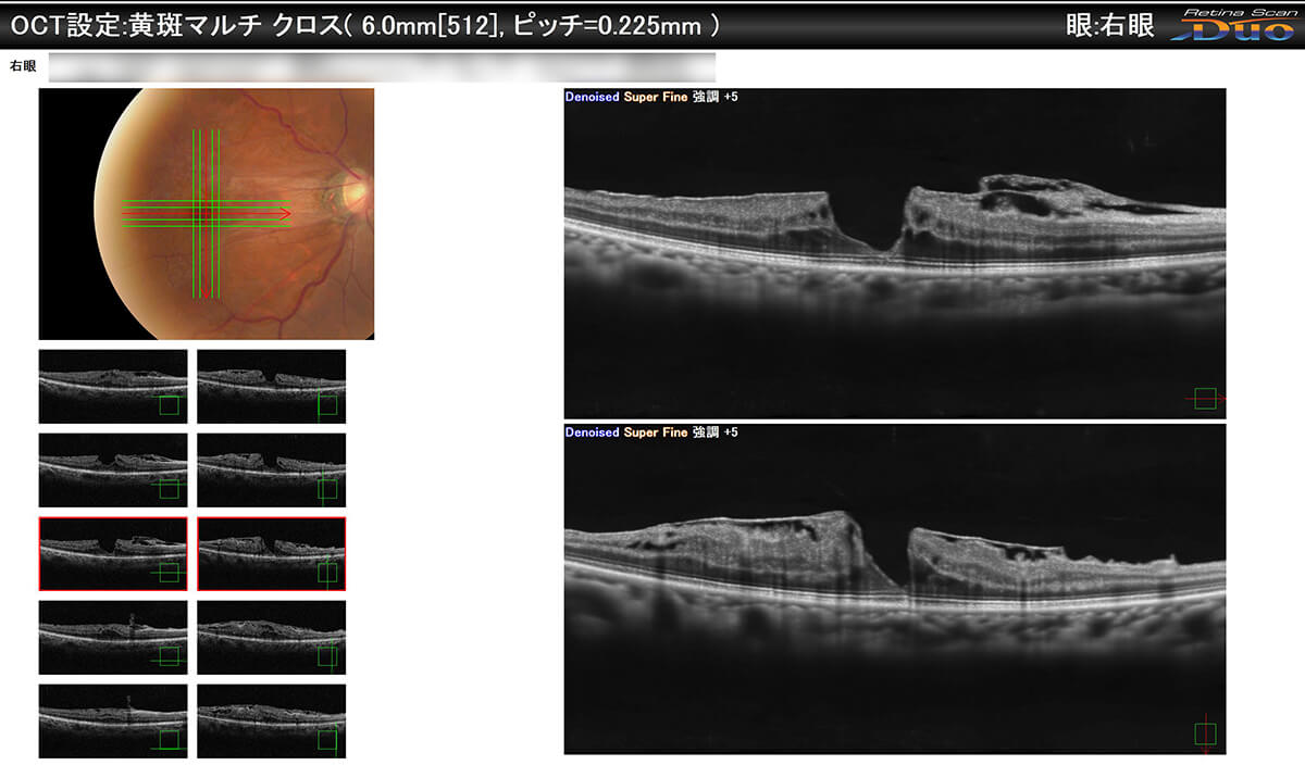 黄斑円孔+黄斑前線維症 手術前・手術後